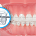 Niềng răng mắc cài sứ có nhược điểm gì?