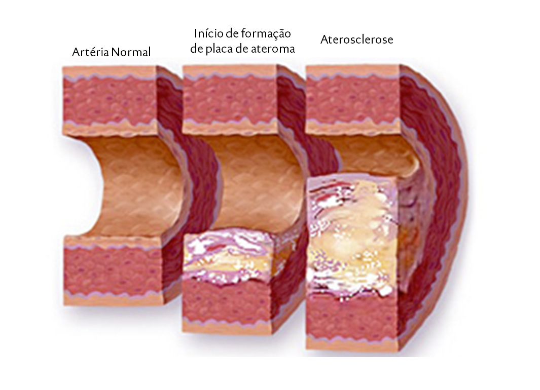Diagrama De Aterosclerose