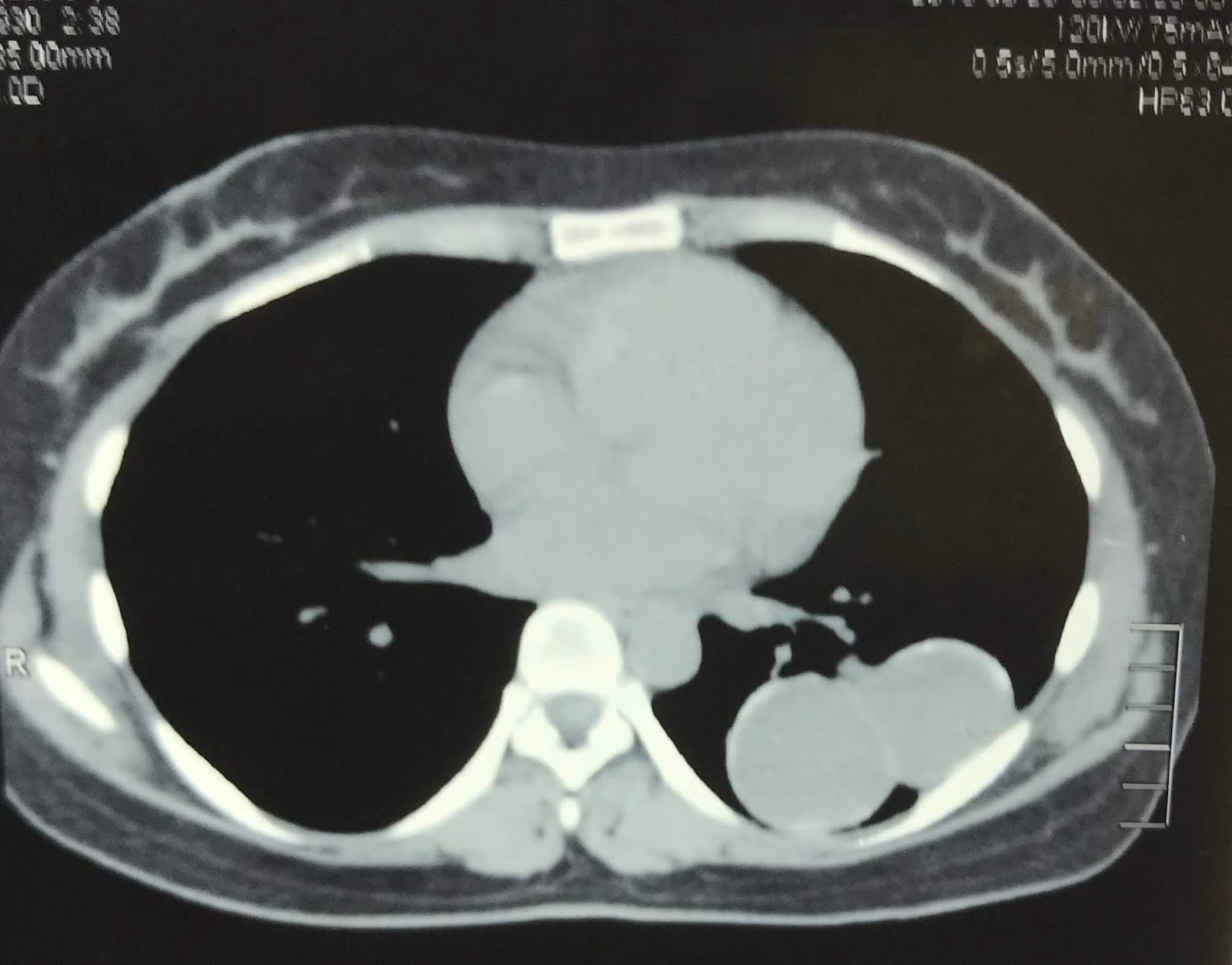 VIETNAMESE MEDIC ULTRASOUND CASE 571 LUNG CYST, Dr PHAN THANH HAI
