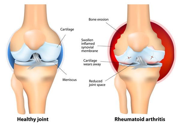 Rheumatoid arthritis