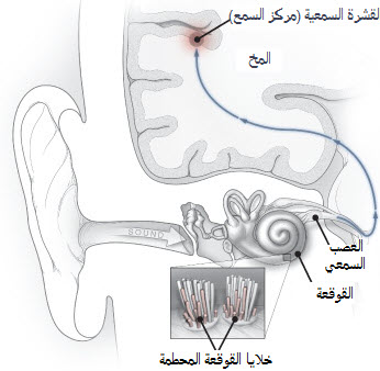 طنين الأذن يسبب تشخيص علاج الصفير