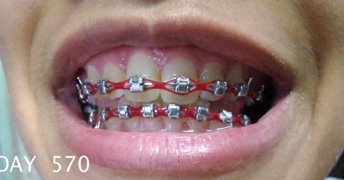 Pengalaman Setahun Tujuh Bulan dengan Braces fatimahnabila