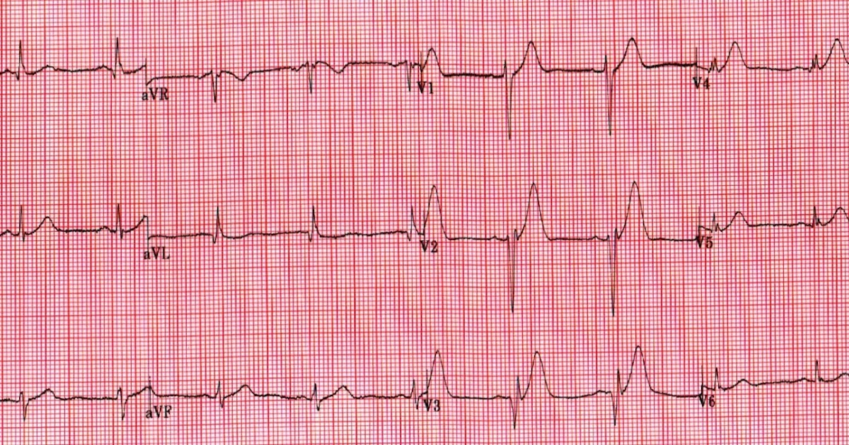 Dr. Smith's ECG Blog 32 yo with right sided chest pain. Zero ST