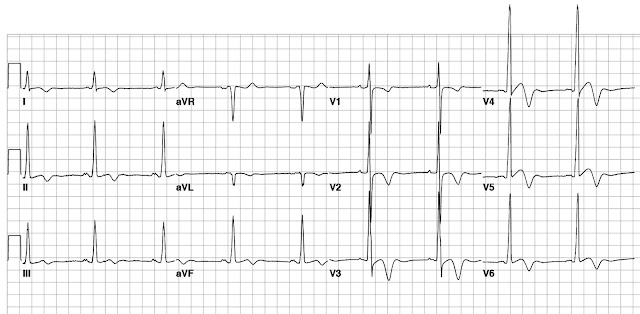 EKG Kardiomiopati Hipertrofik