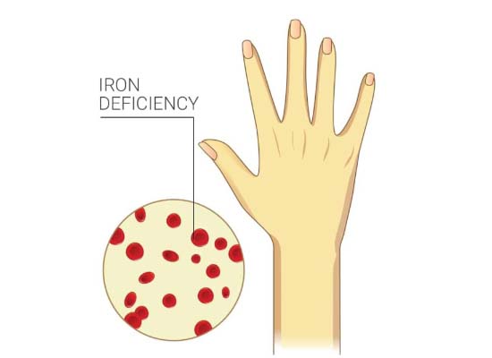 Know the symptoms of iron deficiency in the body