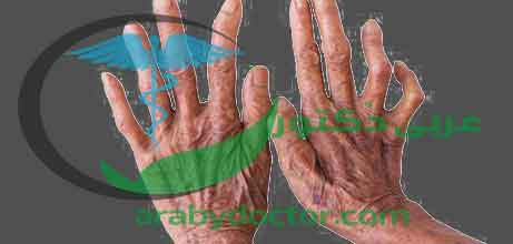 ماهو الجزام؟اسبابه,تشخيص,طرق الانتقال والعلاج ماهو الجزام؟اسبابه,تشخيص,طرق الانتقال والعلاج