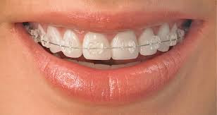 Ưu điểm củan niềng răng cố định là gì?