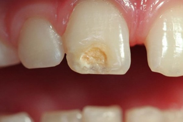 Hipoplasia del esmalte dental, un defecto que aparece en la niñez (Odontología)