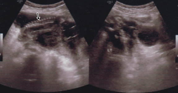 Journal of Postgraduate Gynecology & Obstetrics: Cesarean Scar Ectopic