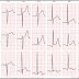 What is ECG