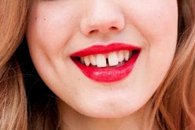 Đầy đủ nguyên nhân vì sao răng bị thưa?