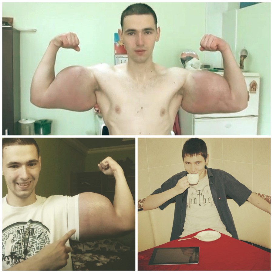 Le foto delle braccia del culturista russo al Synthol su Instagram diventano virali