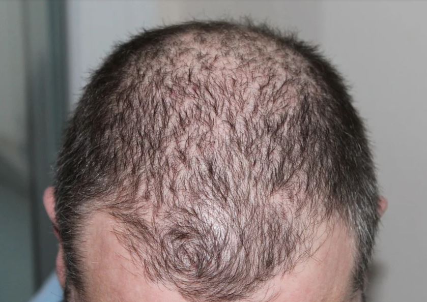 Hair Loss on a Vegan Diet? Get to Know the Details FISHMEATDIE