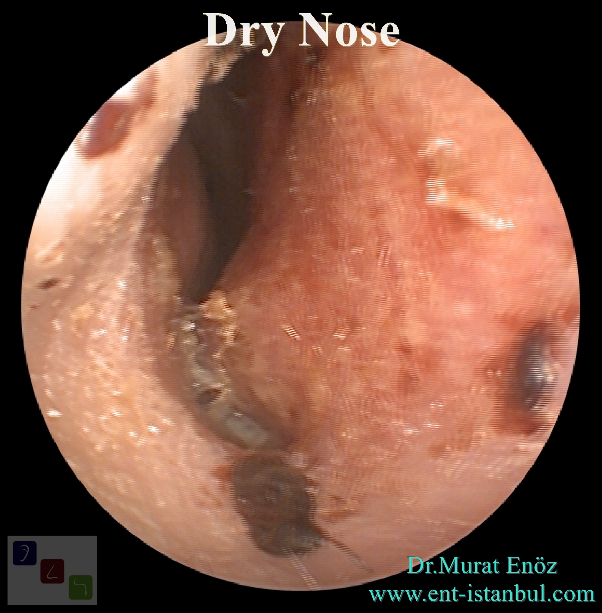 Dry Nose Causes, Treatment, Home Remedies