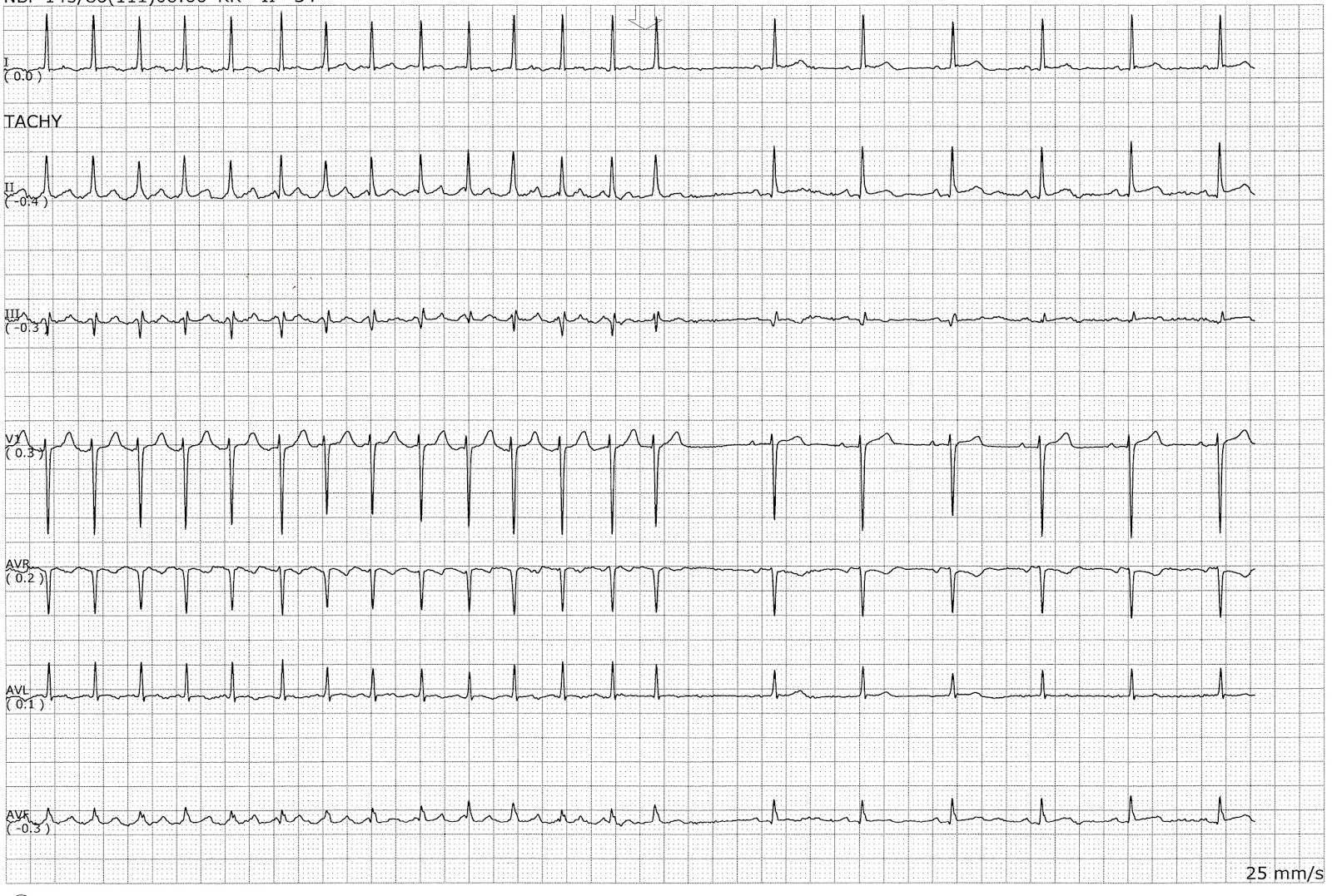 cardizem for afib