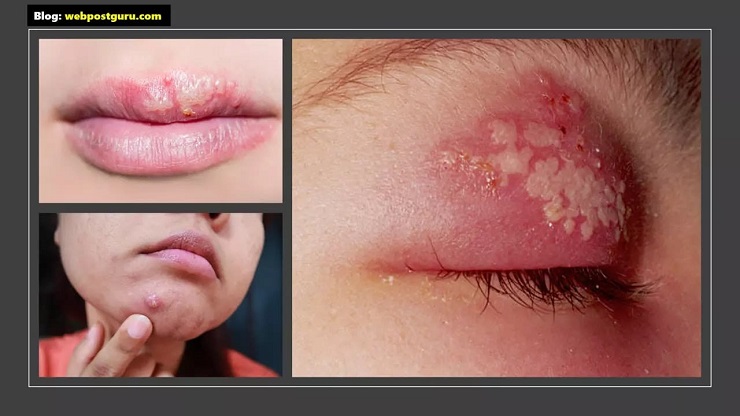 Harpies skin disease images in Hindi,जनेऊ रोग, Herpes virus