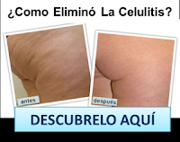 Antes Y Después Del Tratamientos Para La Celulitis