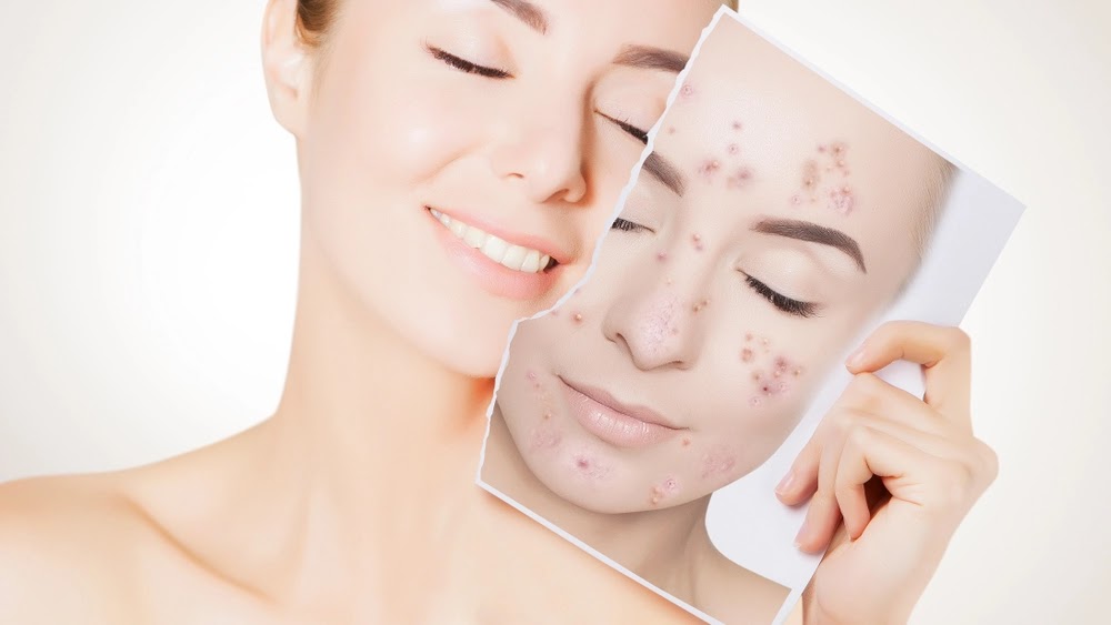 Aloe Vera untuk Jerawat: 7 Cara untuk Menghilangkan Jerawat Aloe Vera untuk Jerawat