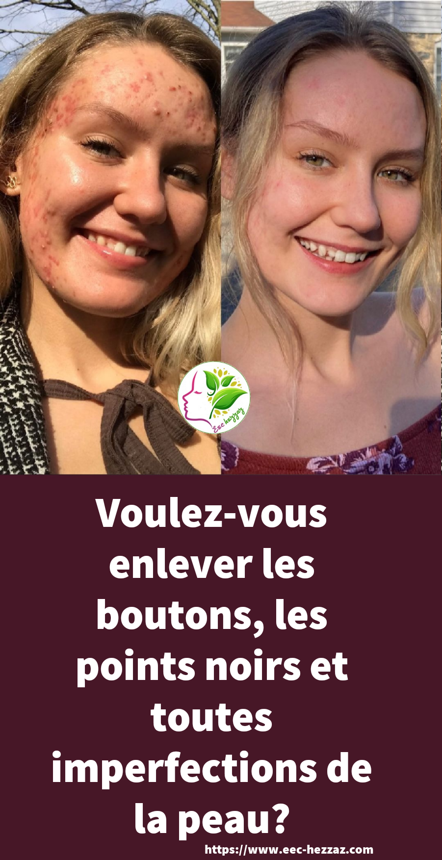 Voulez-vous enlever les boutons, les points noirs et toutes imperfections de la peau?