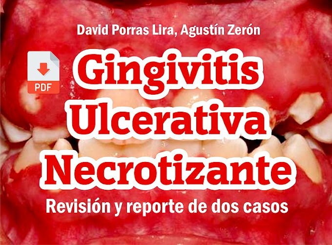 PDF: Gingivitis Ulcerativa Necrotizante - Revisión y reporte de dos casos