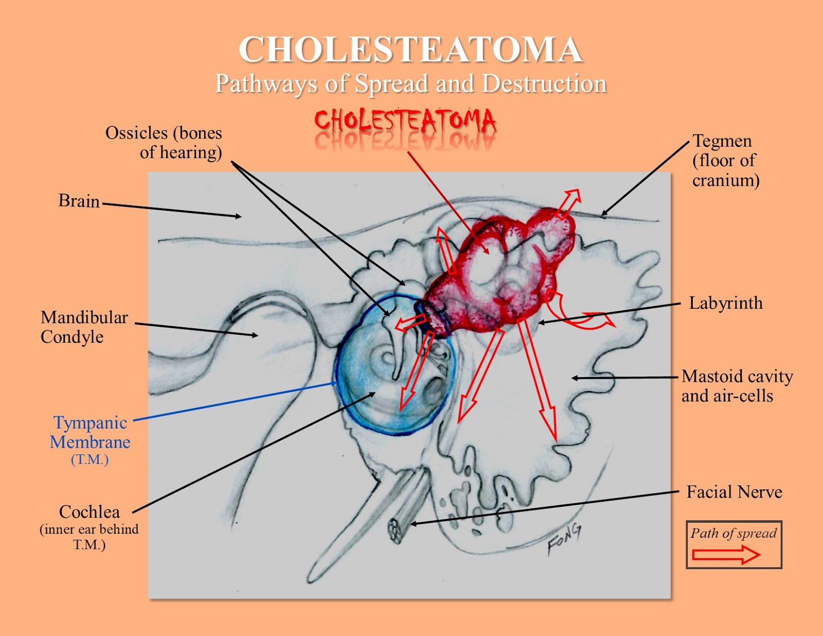 Cholesteatoma A Perplexing Disease of the Ear