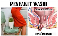 Obat Wasir Tradisional Ambejoss Mujarab Mengobati Benjolan di Anus