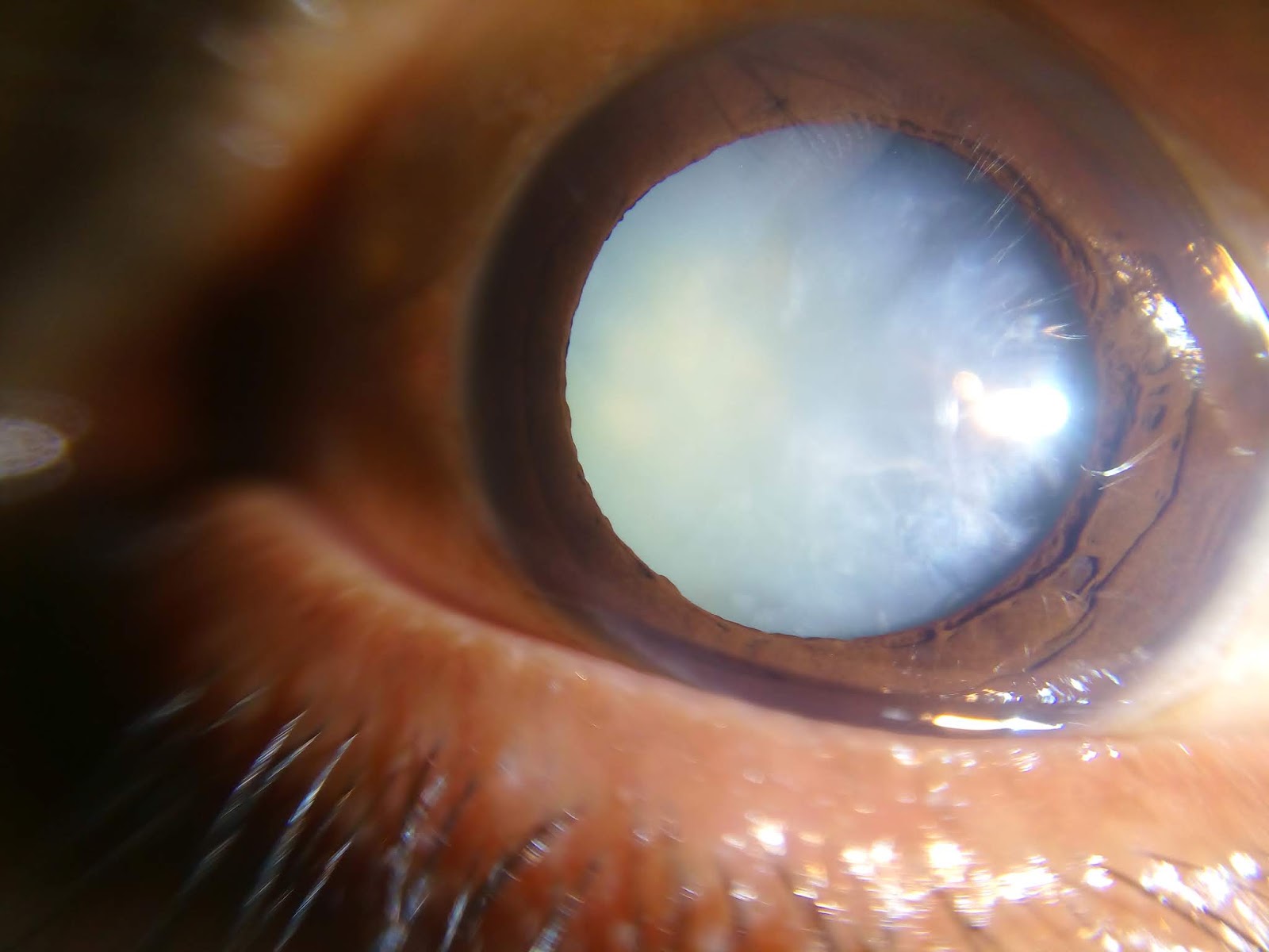 What can patients expect from cataract surgery ? EYE