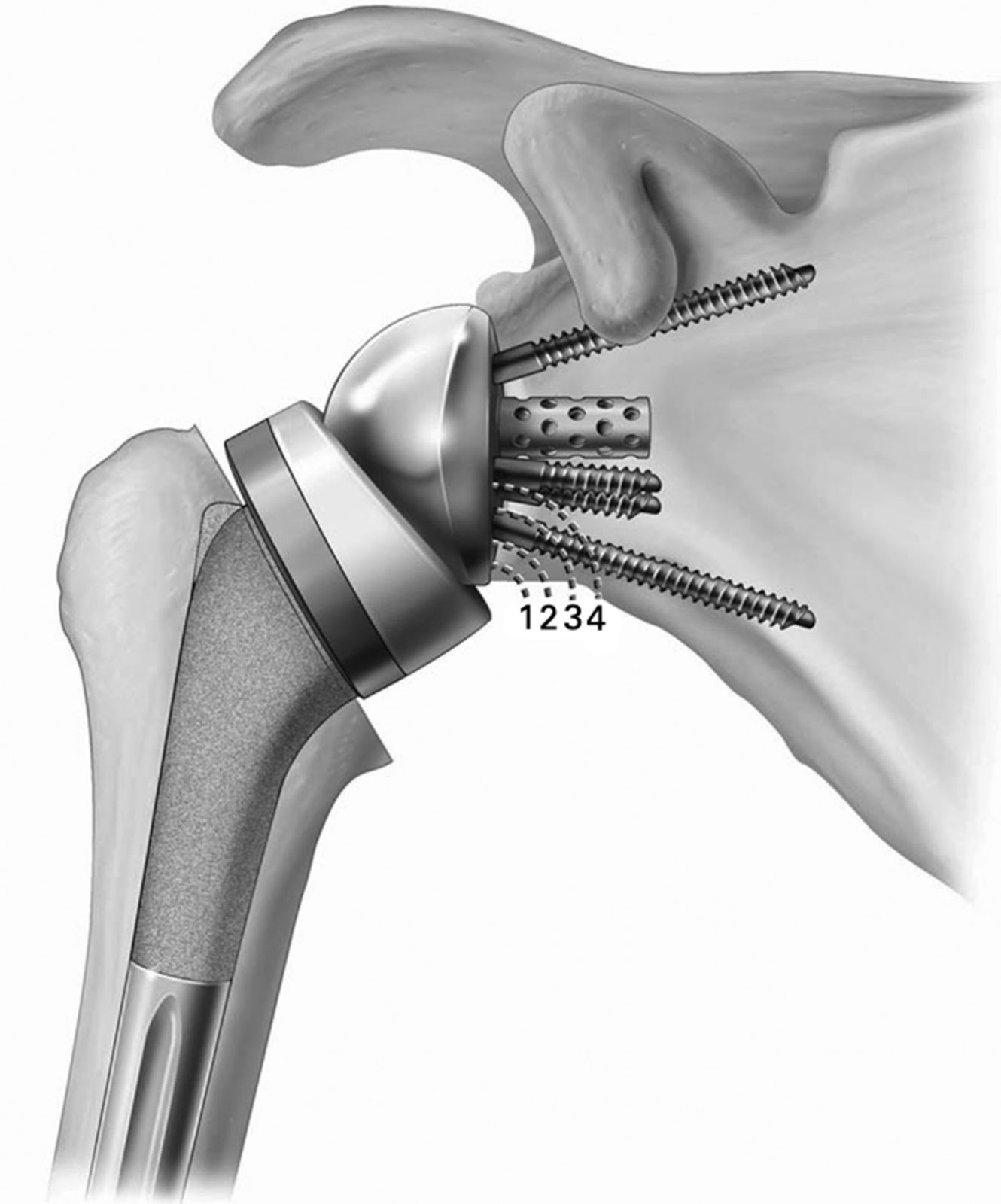 PAT's ART JOURNAL Total Reverse Shoulder Replacement Scheduled for