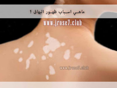 ماهي اسباب ظهور البهاق؟ البهاق,Vitiligo,امراض,الجلد,كيف اتاكد من البهاق,كريم البنكوين,علاج البهاق بالليزر