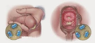 Penyakit Di Kelamin Keluar Nanah