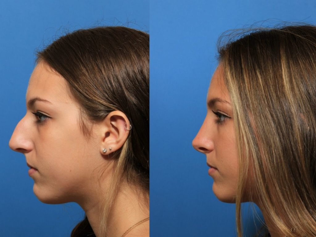 What Is A NonSurgical Nose Job?