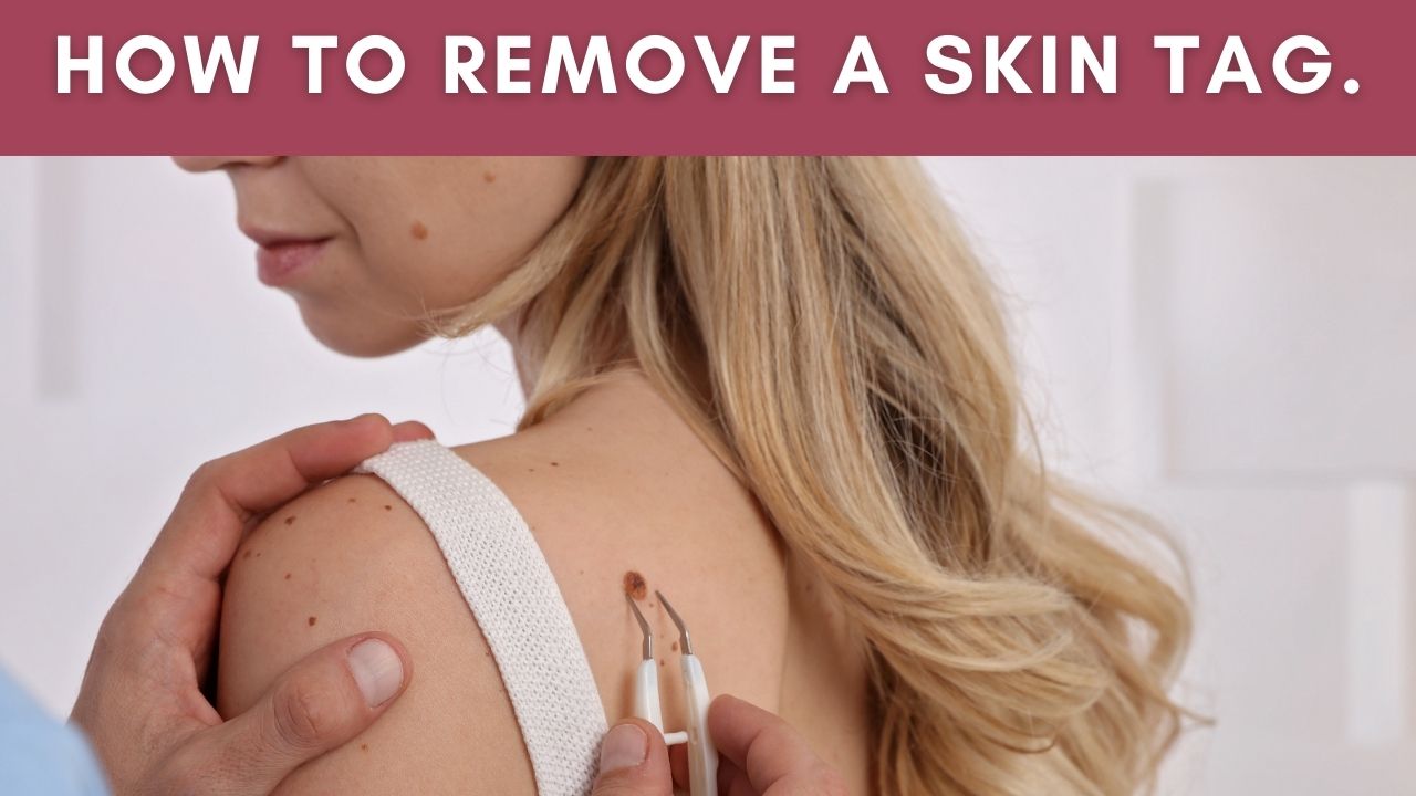 Skin-Tags-causes-symptoms-on-neck-treatment-2021
