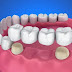 Dental Bridges: Pros and Cons