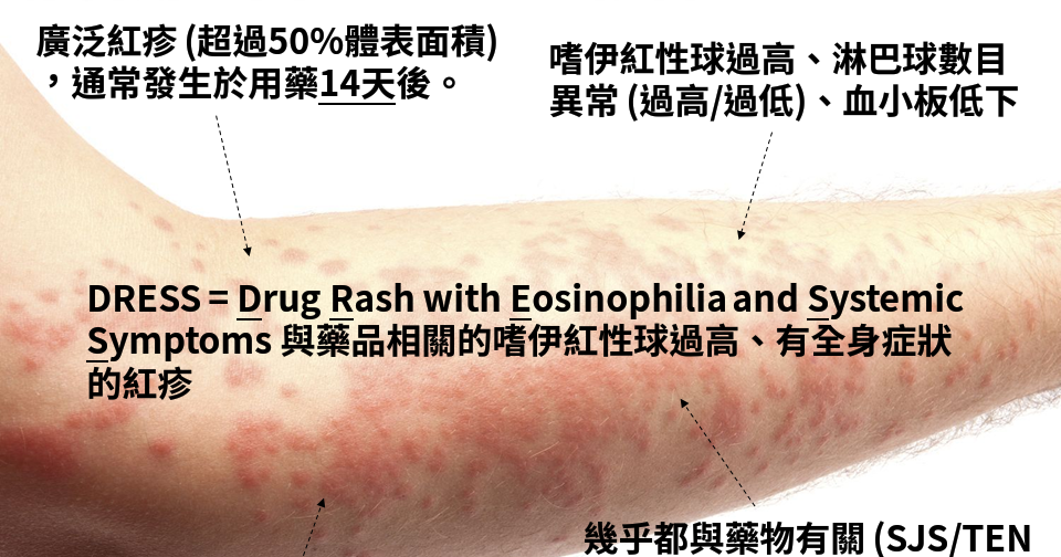 [臨床藥學] 藥品不良反應DRESS症候群 - NEJS