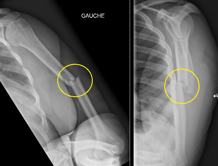Un Jour En Chirurgie Orthopedique Et Traumatologique Traitement