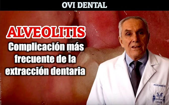 ALVEOLITIS: Complicación más frecuente de la extracción dentaria - Dr. Rafael Ruíz Rodríguez