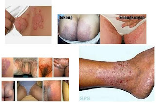 Kenapa Pantat atau bokong Sering Gatal Gatal