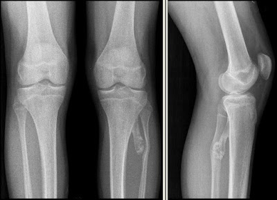 Osteochondroma of the tibia