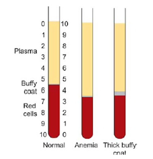 Anticoagulated blood-filled Wintrobe hematocrit tubes after centrifugation, showing normal PCV, low PCV (anemia), and thick buffy coat layer