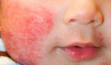 Gangguan Alergi Pada Bayi Karena Alergi Susu Sapi