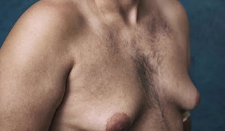  تضخم الثدي عند الرجال  ماهي اسبابه و طرق علاجه
