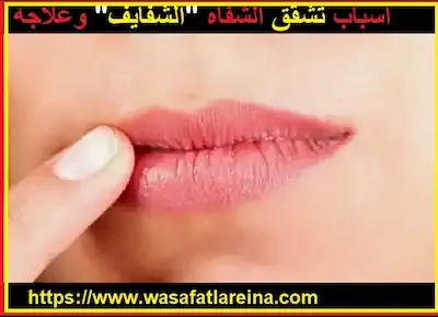 وصفات طبيعية لعلاج تشقق الشفاه واسبابه