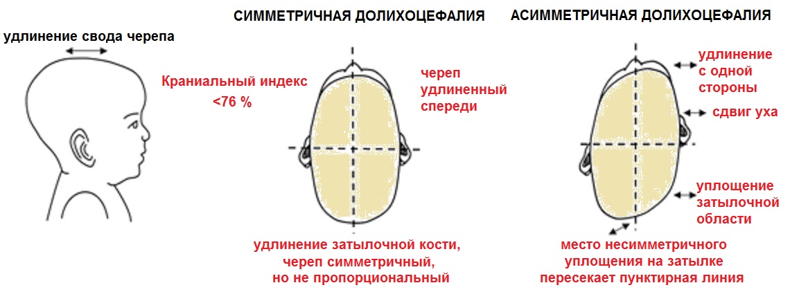 сочетание долихоцефалии и непропорционального искривления формы черепа