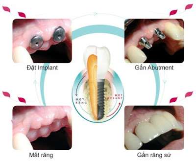  Cấy ghép răng Implant thực hiện như thế nào?