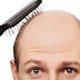 15 Natural Home Remedies to Cure Male Baldness