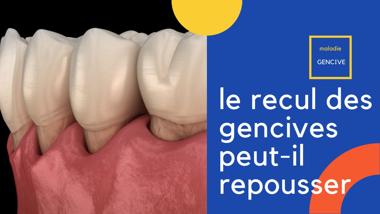 Le recul des gencives Peuventelles repousser naturellement? • SoinDentaire