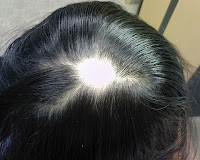 rambut rontok alopecia areata