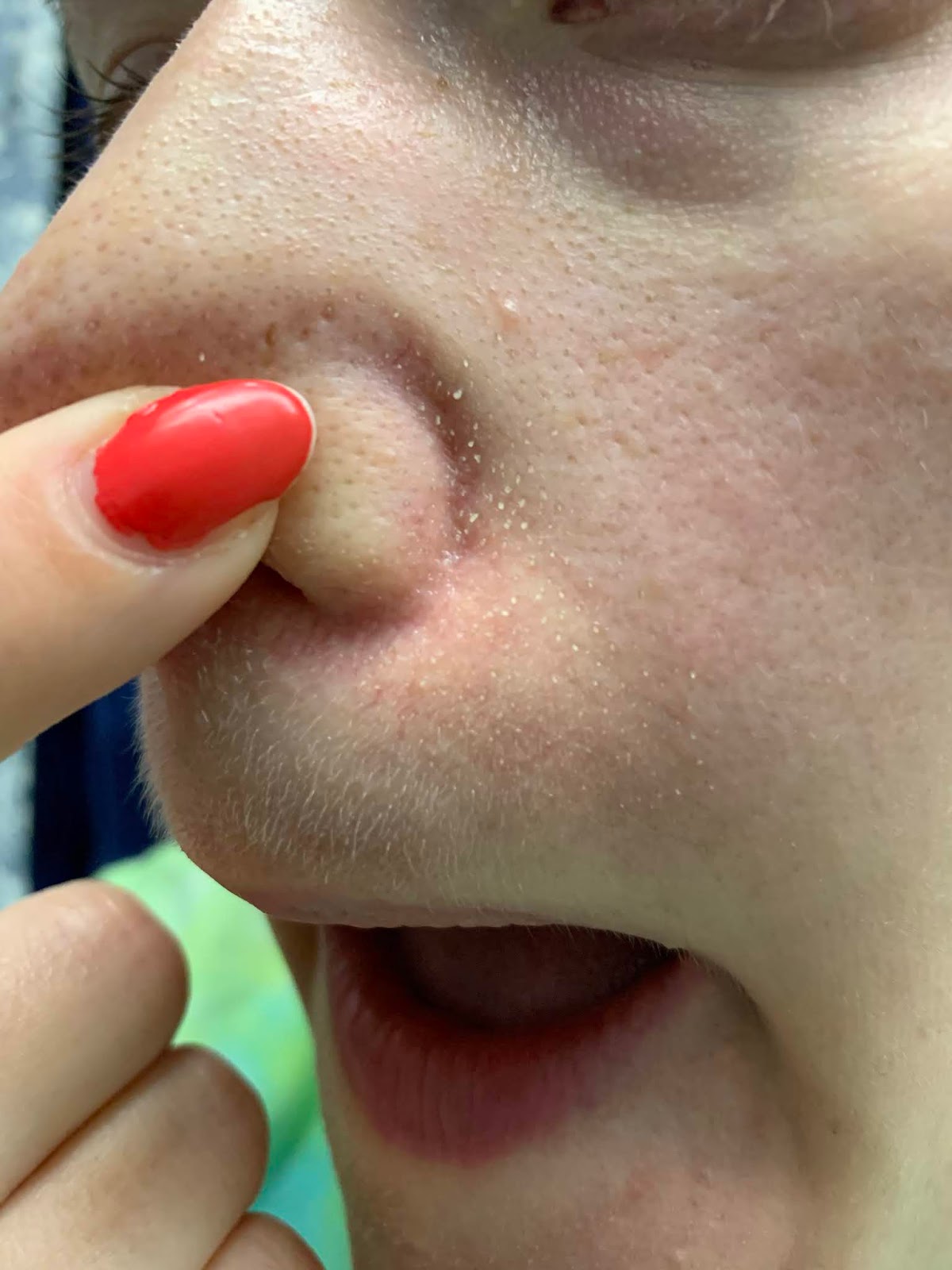 Dermaflash Dermapore Pore Extractor Review Connecticut Fashion and