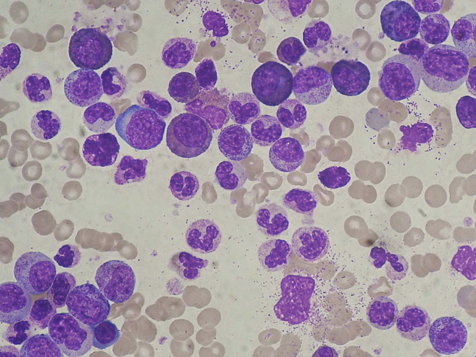 Células importantes en hematología DESVIACION A LA IZQUIERDA Células importantes en hematología DESVIACION A LA IZQUIERDA