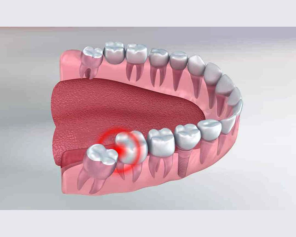 What Problems Can Wisdom Teeth Cause Odontovida